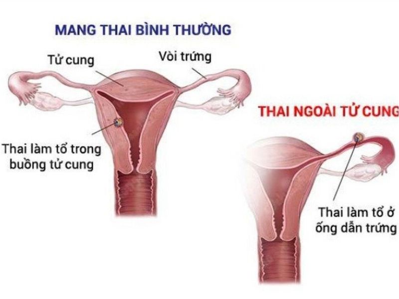 Như thế nào gọi là thai ngoài tử cung?