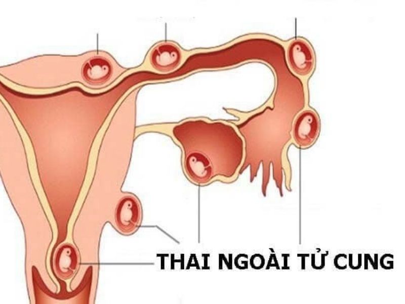 mấy tuần thì biết thai ngoài tử cung